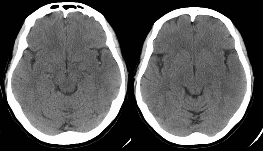 Mca Infarction Dot Sign 7396